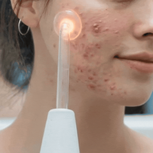 Portable High Frequency Facial Wand  Clear Breakouts, Calm Redness & Restore Skin Confidence Fast